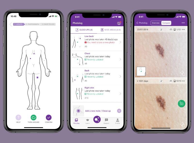 New app helps prevent skin cancer using AI and ML